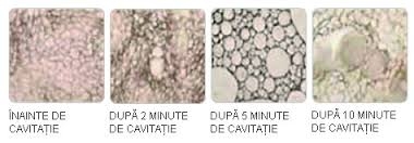 cum acționează liposucția virtuală